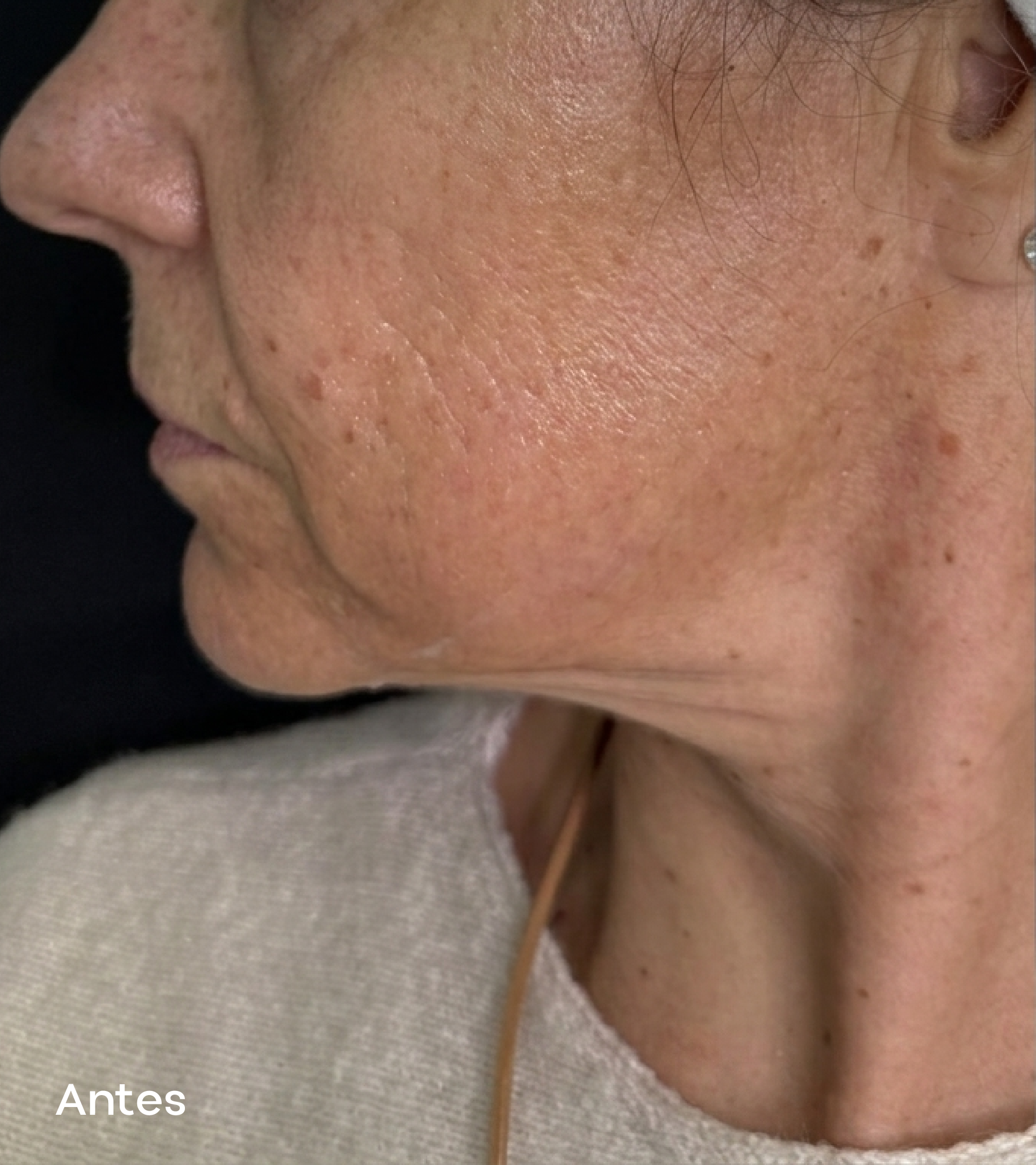 Resultados faciales