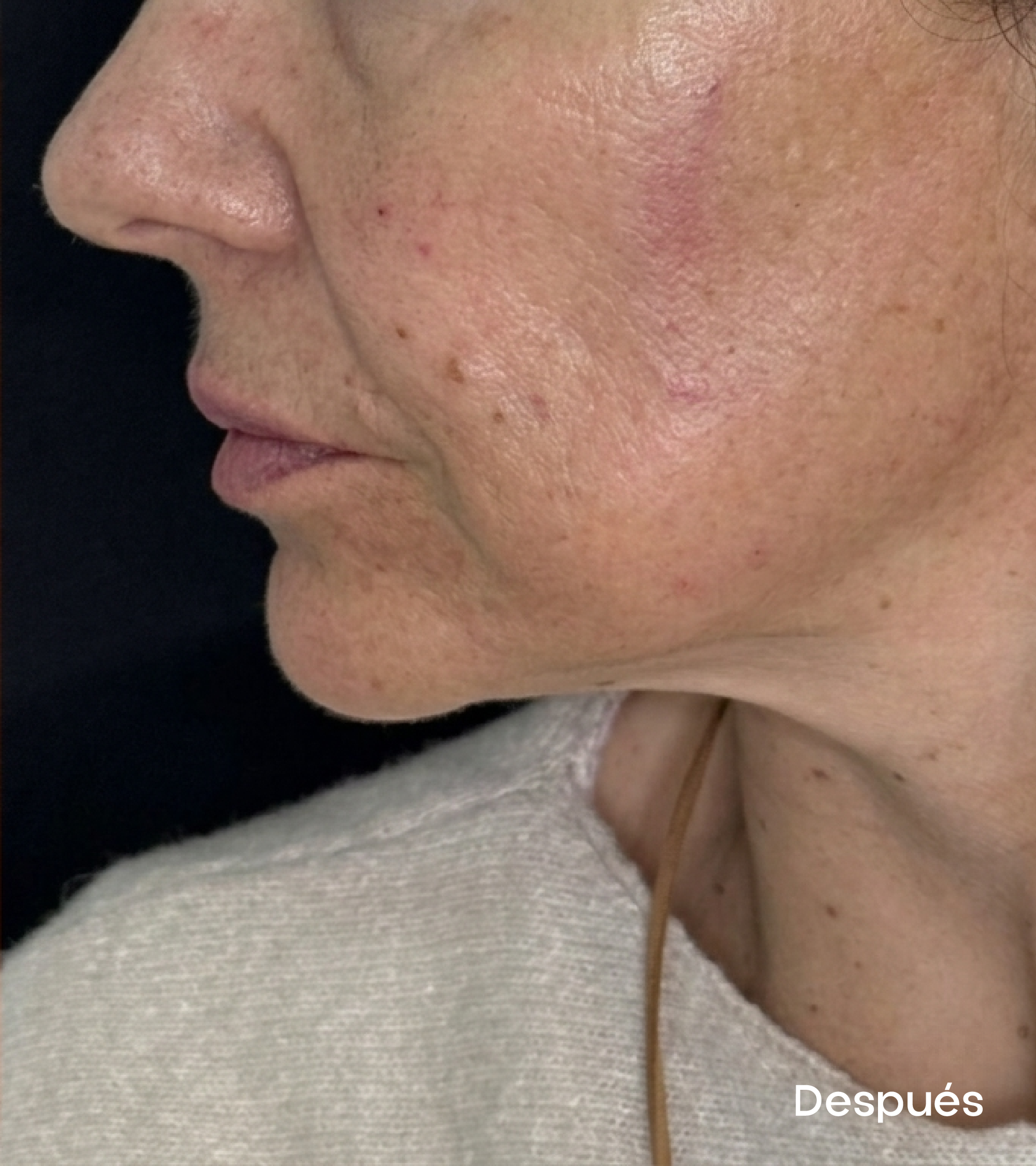 Resultados faciales