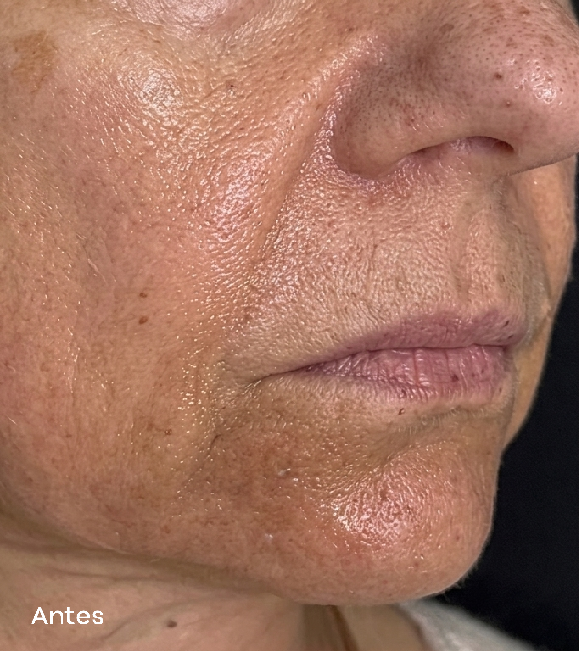 Resultados faciales