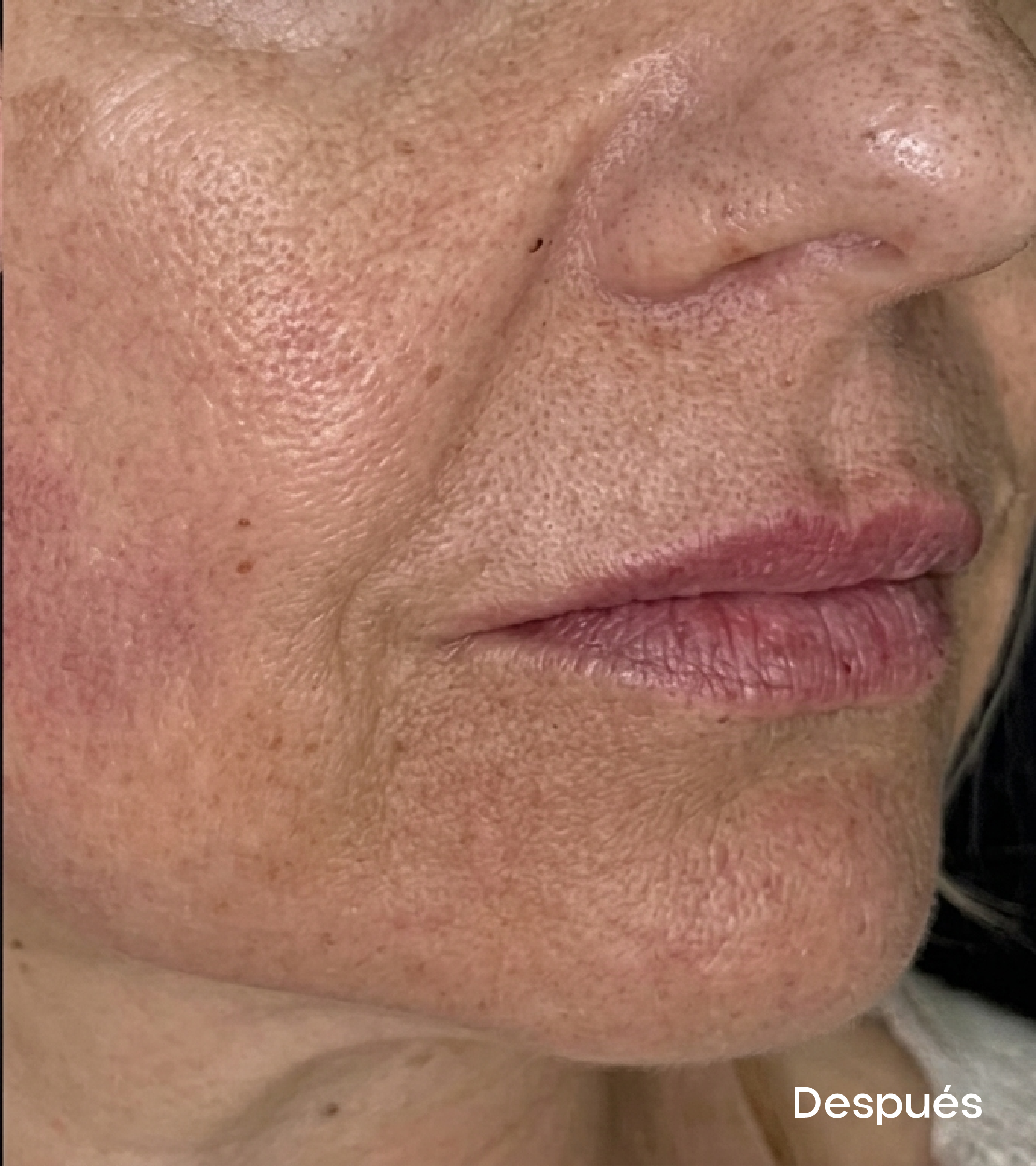 Resultados faciales