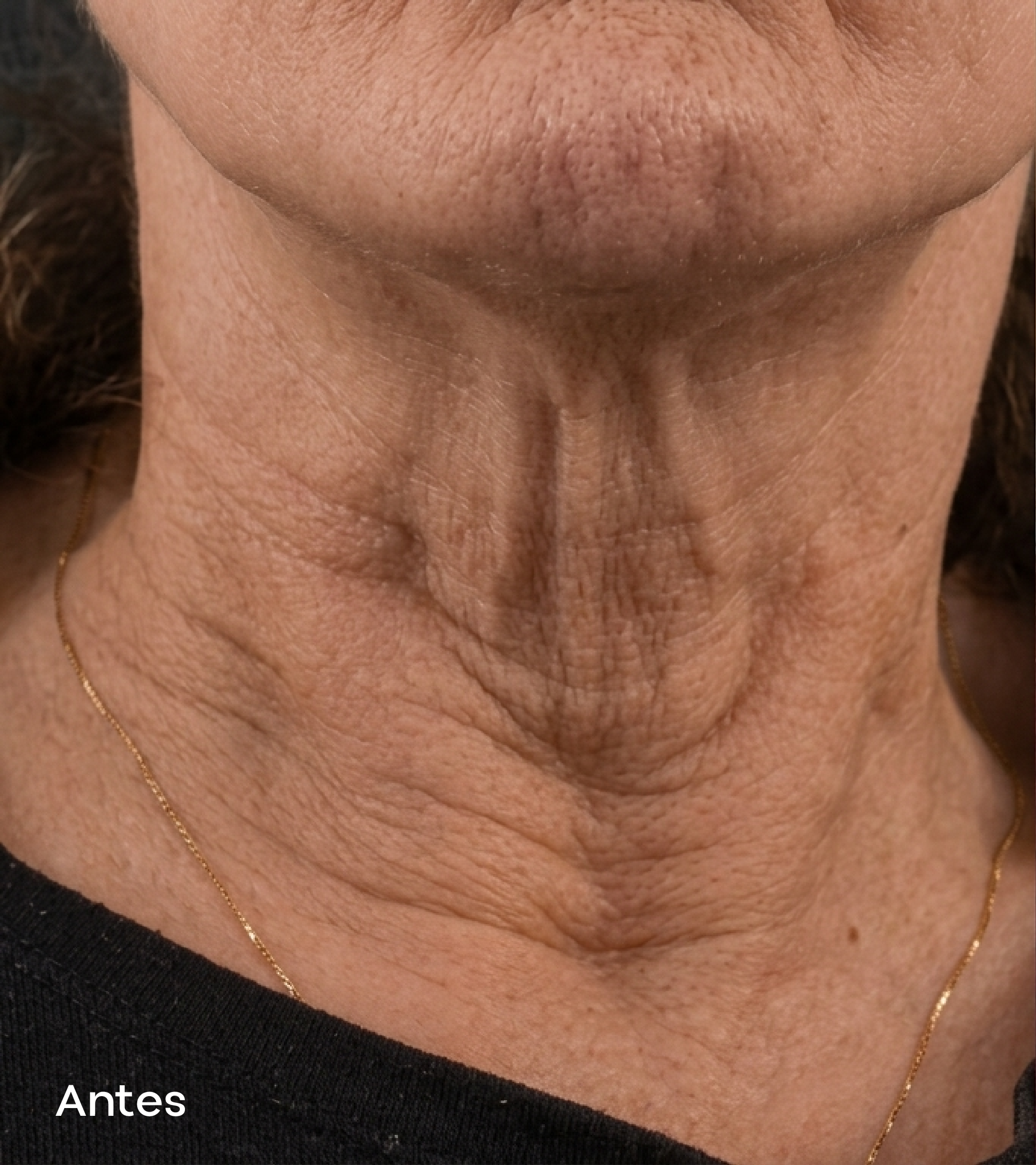 Resultados faciales